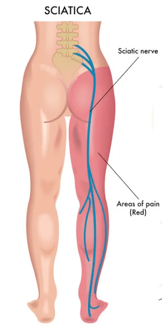 sciatica diagram