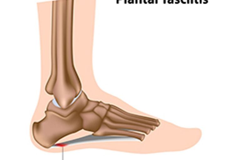 plantar fasciitis specialist